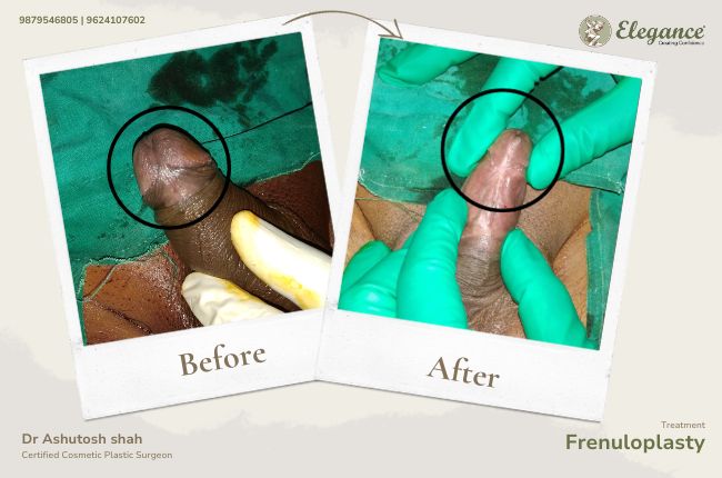 Frenuloplasty (2)