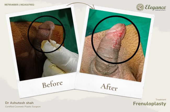 Frenuloplasty (4)