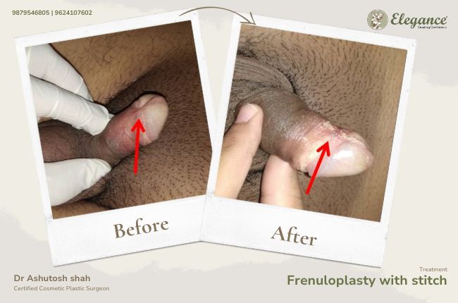 Frenuloplasty with stitch