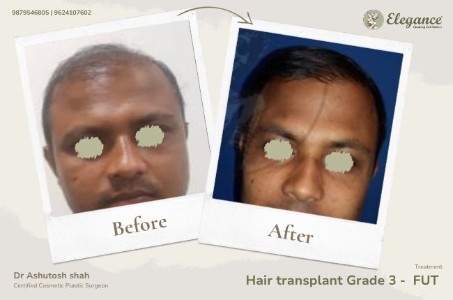 Hair transplant Grade 3 - FUT (2)