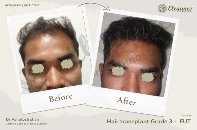 Hair transplant Grade 3 - FUT (3)