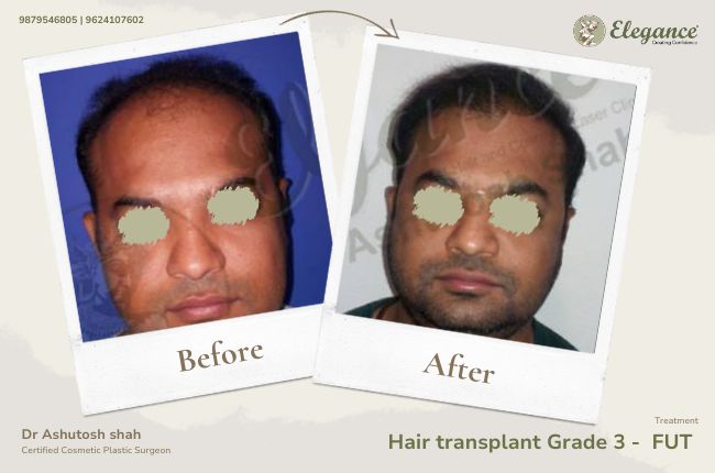 Hair transplant Grade 3 - FUT