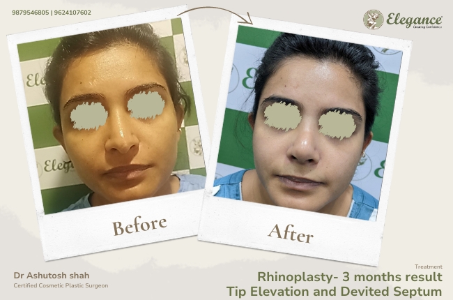 Rhinoplasty- 3 months result Tip Elevation and Devited Septum 23