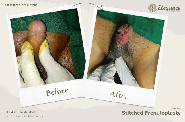 Stitched Frenuloplasty (2)