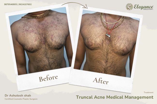 Truncal Acne Medical Management (2)