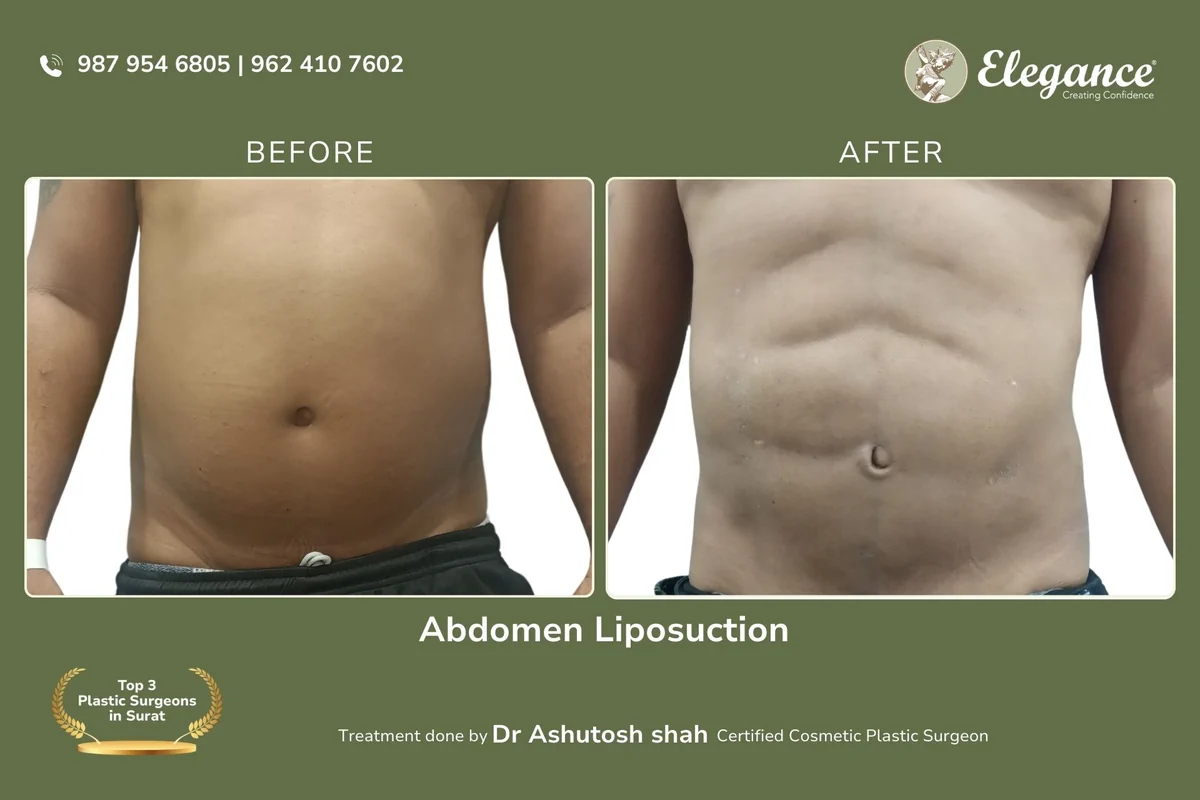 Abdomen Liposuction