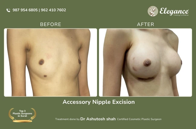 Accessory Nipple Excision