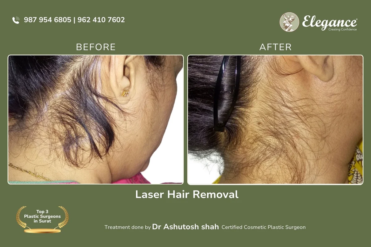 Laser Hair Removal