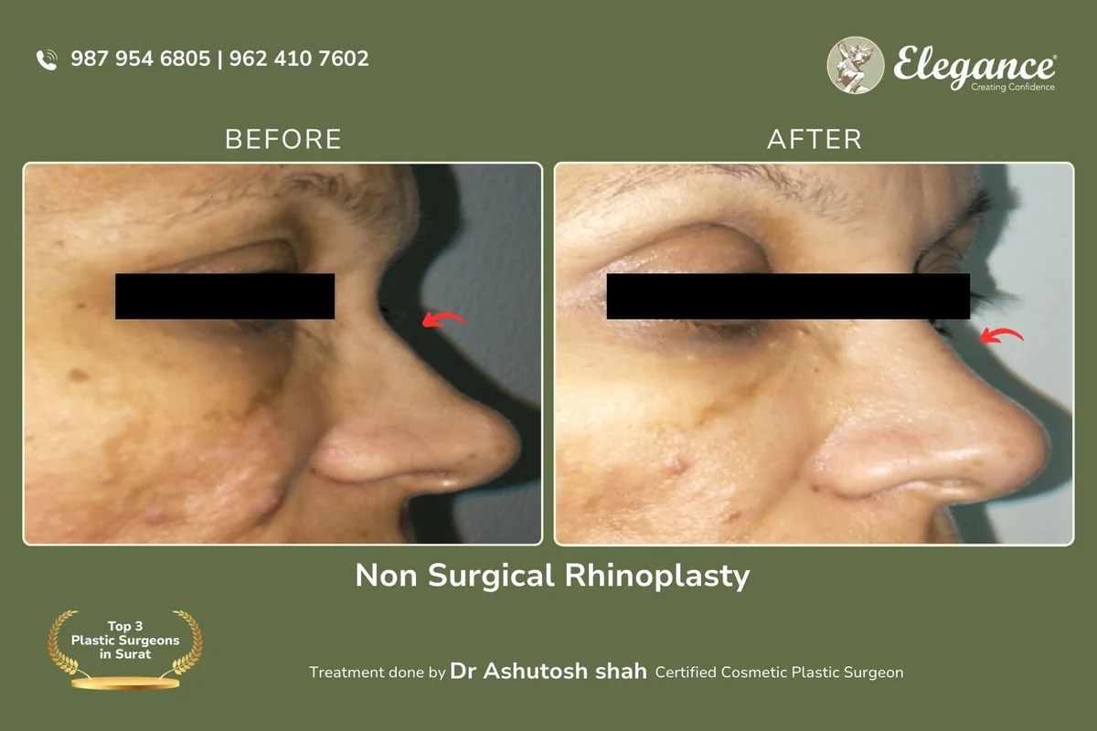 Non Surgical Rhinoplasty (1)