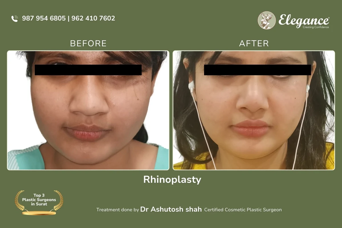 Rhinoplasty