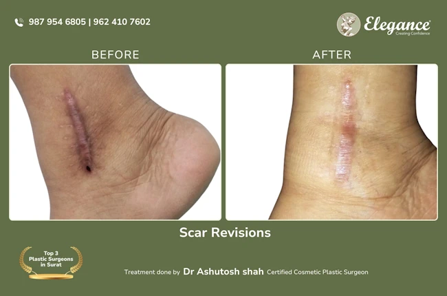 Scar Revisions