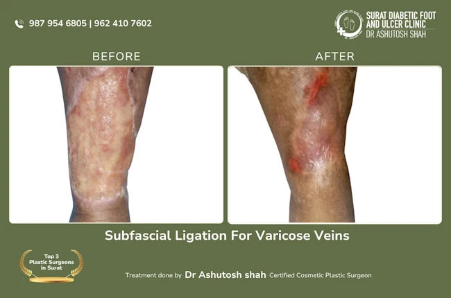 Subfascial Ligation For Varicose Veins