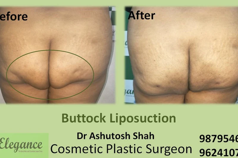 Buttock Liposuction