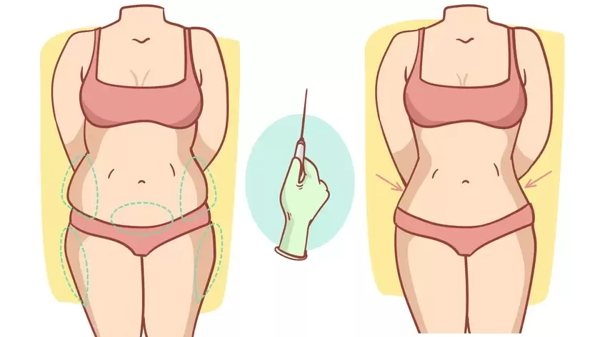 A detailed guide to liposuction surgery, treatments, and benefits at Elegance Clinic.