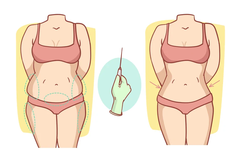 A detailed guide to liposuction surgery, treatments, and benefits at Elegance Clinic.