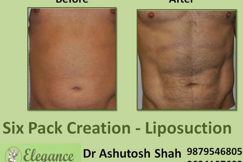 Six Pack Creation - Liposuction