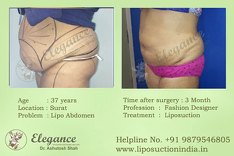 liposuction-transplant-results-surat