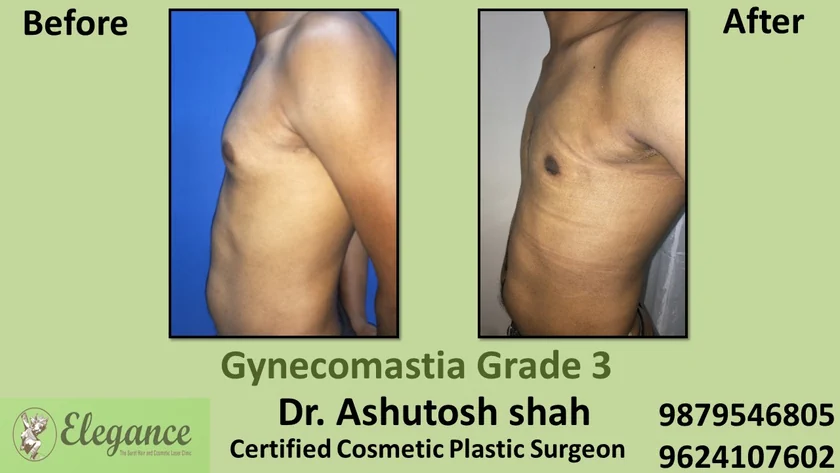 male-breast-reduction-surgery-valsad-gujarat