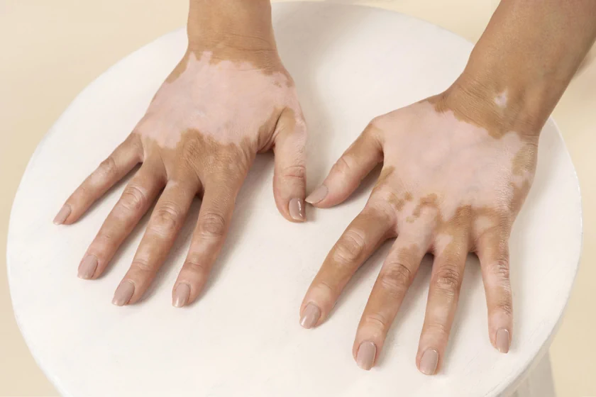 Expert Vitiligo Treatment in Surat, India - Elegance Clinic