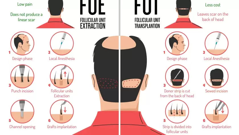 FUE vs FUT