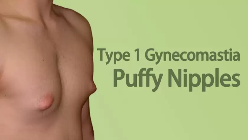 Gynecomastia Type 1