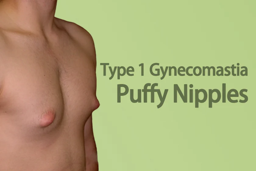 Gynecomastia Type 1